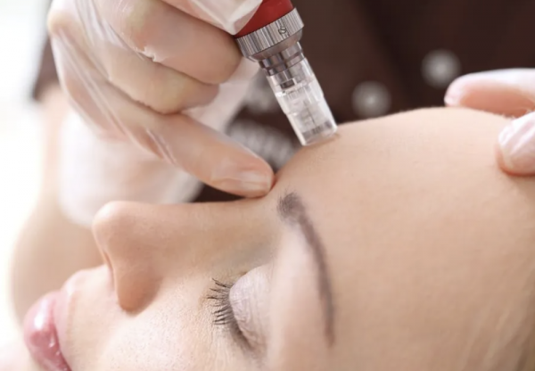 microinfusion facial cheshire wellness clinic